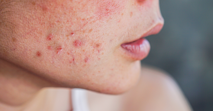 [SOLLE] Inflamação crônica de baixo grau o que é e como pode afetar a saúde da mulher